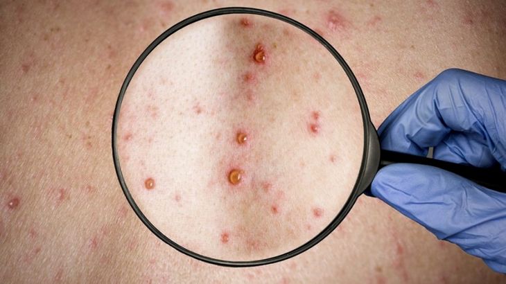 De 40 contagios que cuentan con información sobre la condición de VIH, 33 personas registraron co-infección.
